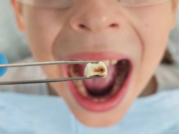 Best Emergency Dental Care for Broken or Chipped Teeth in Lakeland, TN