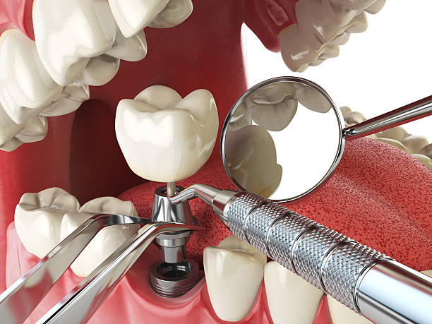 Best Emergency Tooth Extraction in Lakeland, TN